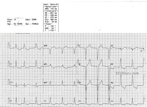 lv branch|severe lvh left bundle.